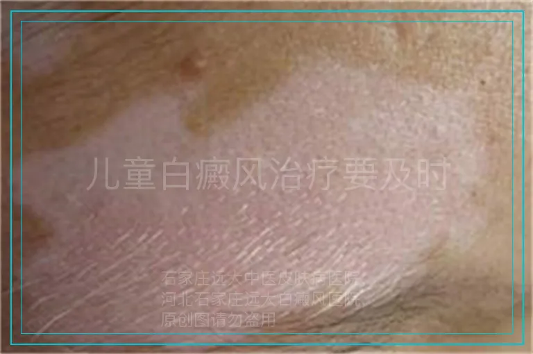 儿童白癜风治疗要及时