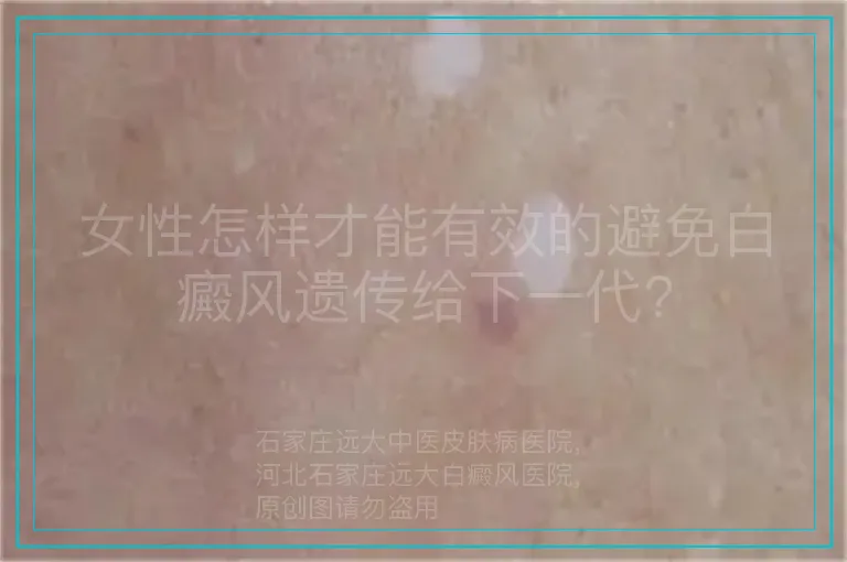 女性怎样才能有效的避免白癜风遗传给下一代?