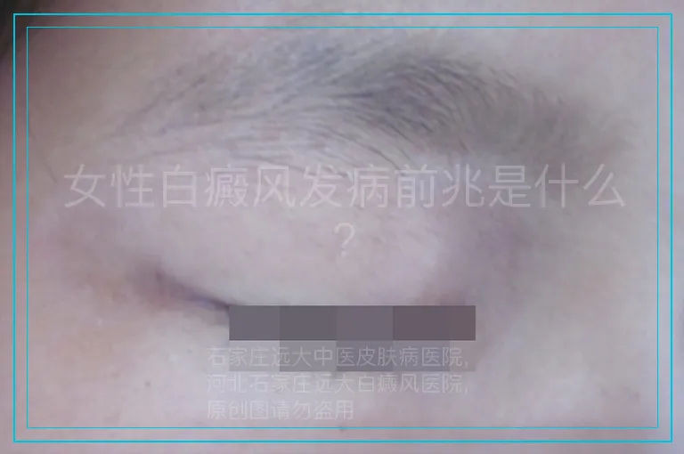 女性白癜风发病前兆是什么?