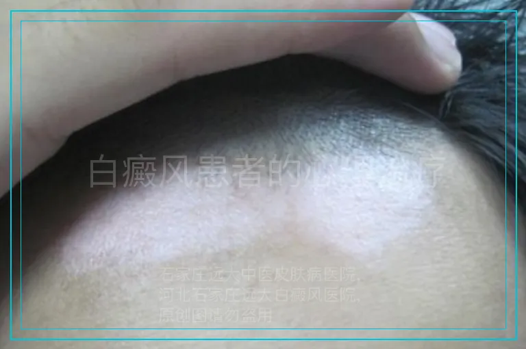 白癜风患者的心理治疗