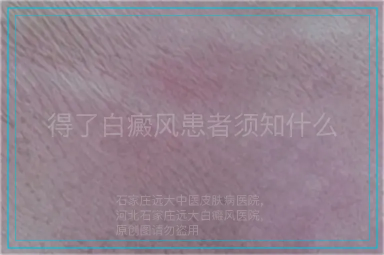 得了白癜风患者须知什么