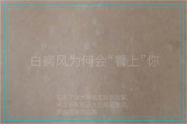 白癜风为何会“看上”你