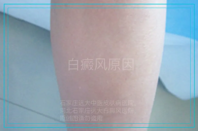 白癜风原因