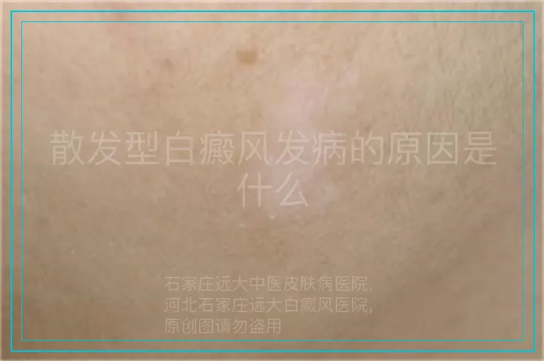 散发型白癜风发病的原因是什么