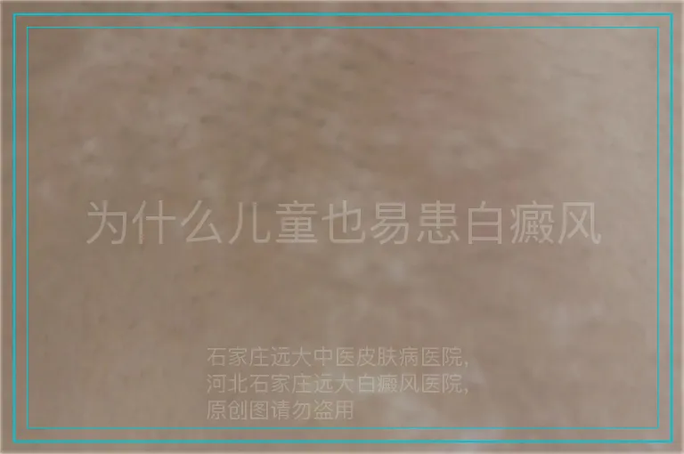 为什么儿童也易患白癜风