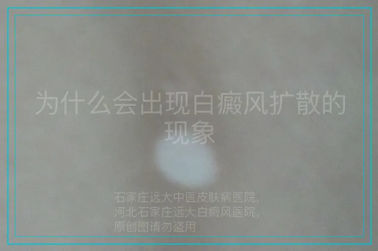 为什么会出现白癜风扩散的现象