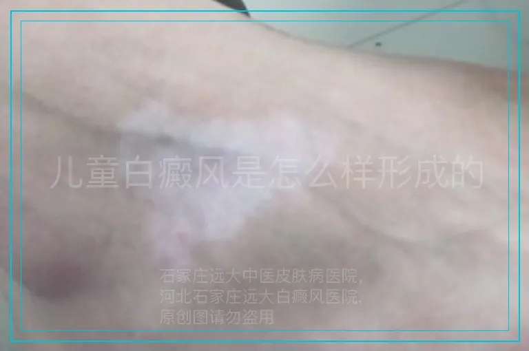 儿童白癜风是怎么样形成的