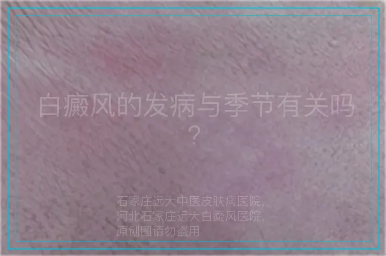 白癜风的发病与季节有关吗?