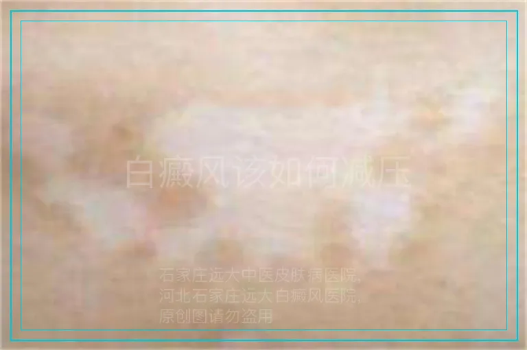 白癜风该如何减压