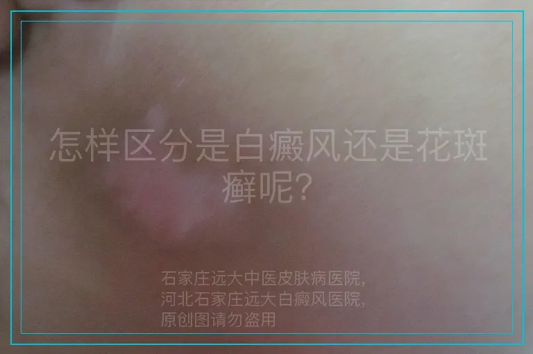 怎样区分是白癜风还是花斑癣呢？