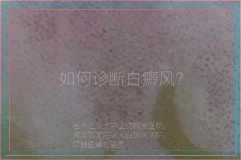 如何诊断白癜风？
