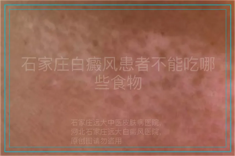 石家庄白癜风患者不能吃哪些食物