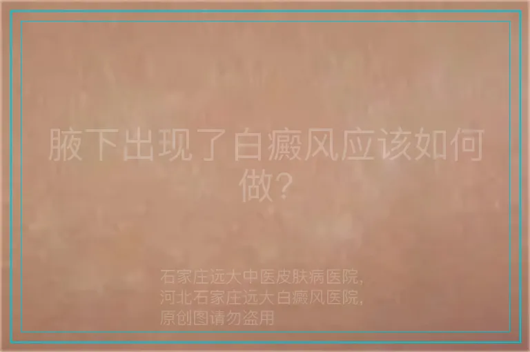 腋下出现了白癜风应该如何做?