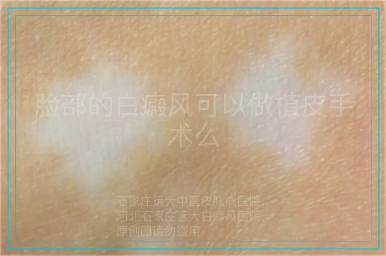 脸部的白癜风可以做植皮手术么