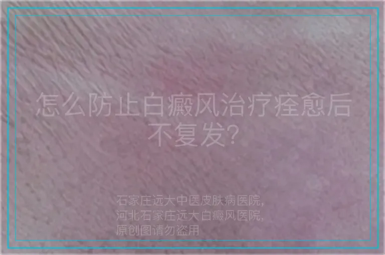 怎么防止白癜风治疗痊愈后不复发?
