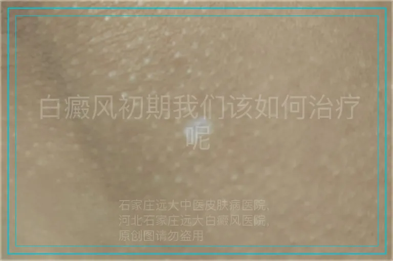 白癜风初期我们该如何治疗呢