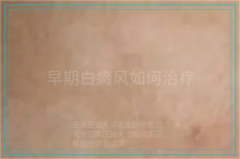 早期白癜风如何治疗