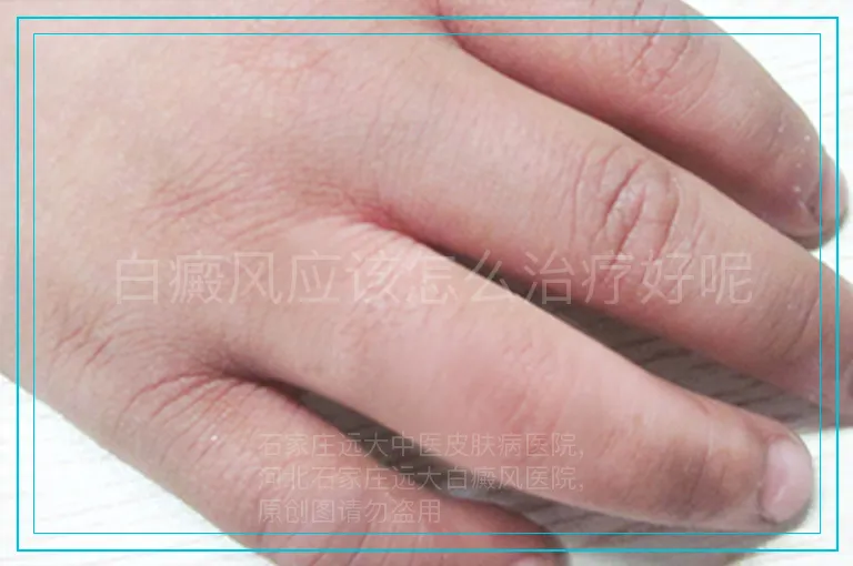 白癜风应该怎么治疗好呢