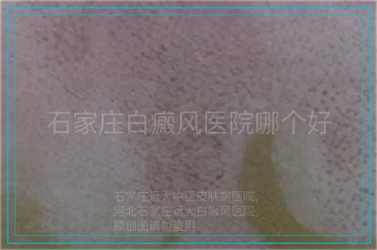 石家庄白癜风医院哪个好