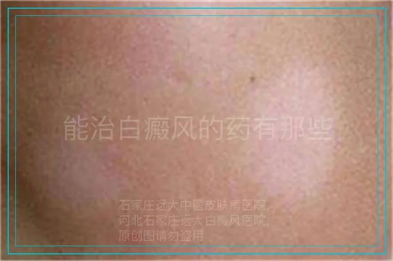 能治白癜风的药有那些