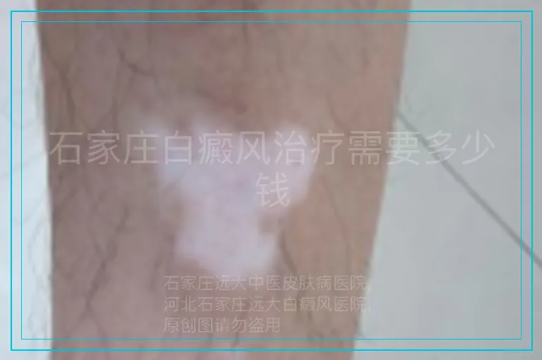 石家庄白癜风治疗需要多少钱