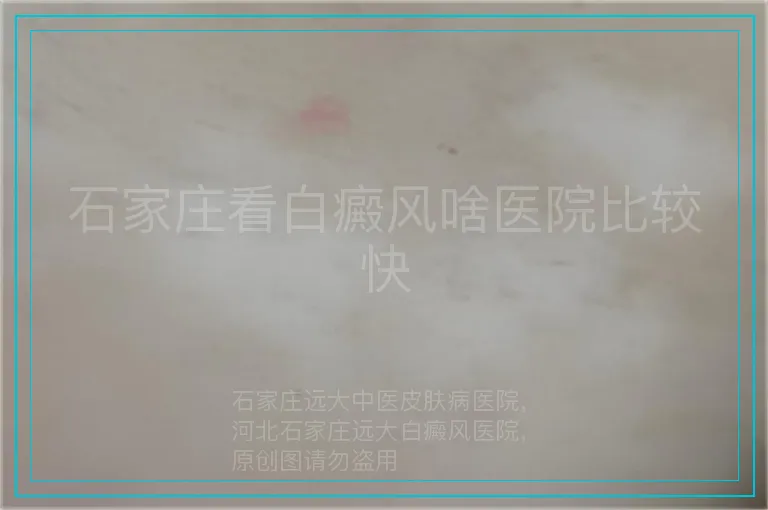 石家庄看白癜风啥医院比较快