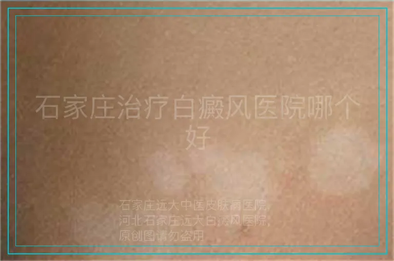 石家庄治疗白癜风医院哪个好
