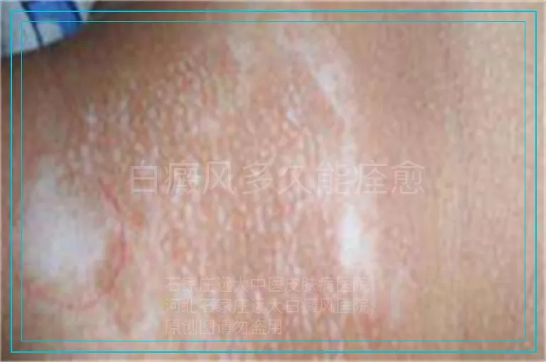 白癜风多久能痊愈