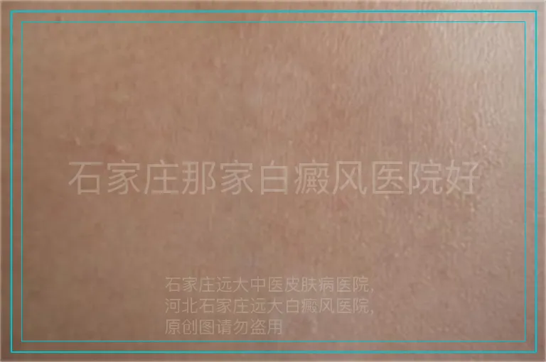 石家庄那家白癜风医院好