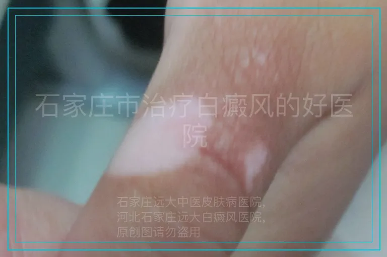 石家庄市治疗白癜风的好医院