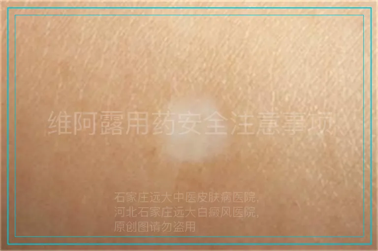 维阿露用药安全注意事项