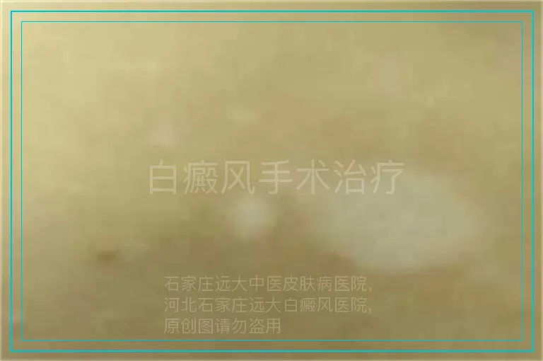 白癜风手术治疗