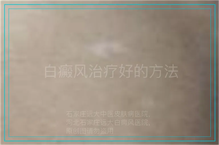 白癜风治疗好的方法