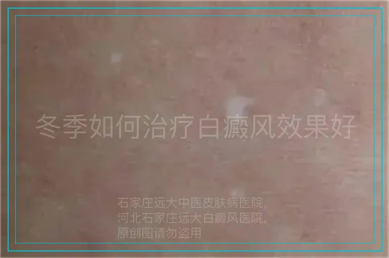 冬季如何治疗白癜风效果好