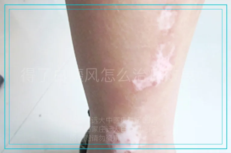 得了白癜风怎么治疗效果好