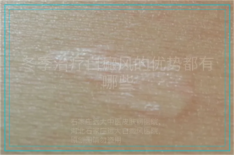 冬季治疗白癜风的优势都有哪些