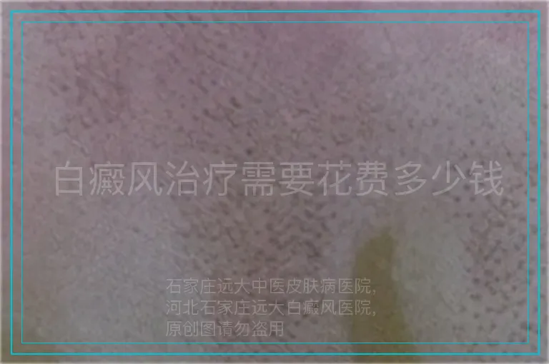 白癜风治疗需要花费多少钱