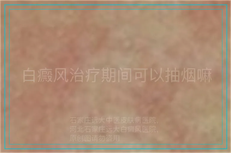 白癜风治疗期间可以抽烟嘛