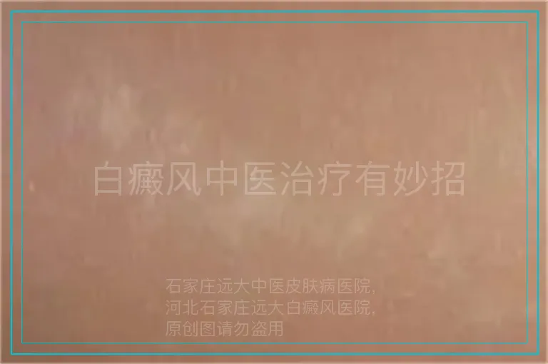 白癜风中医治疗有妙招
