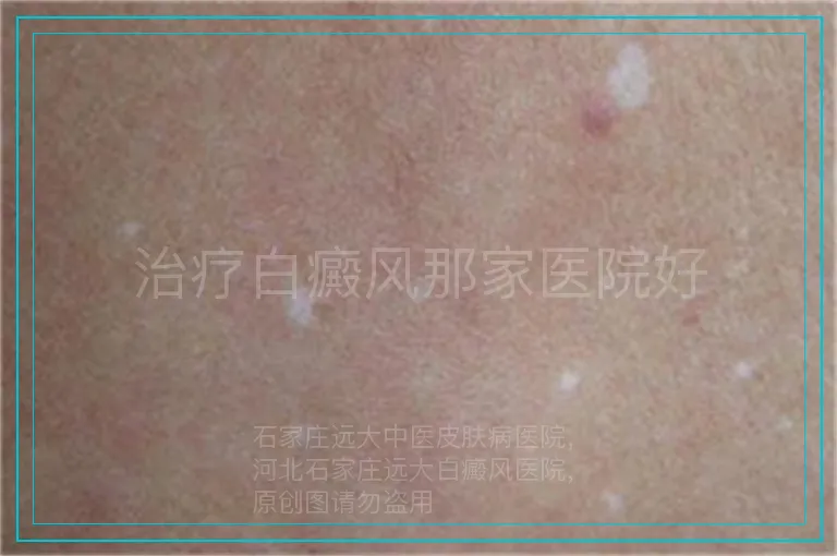 治疗白癜风那家医院好