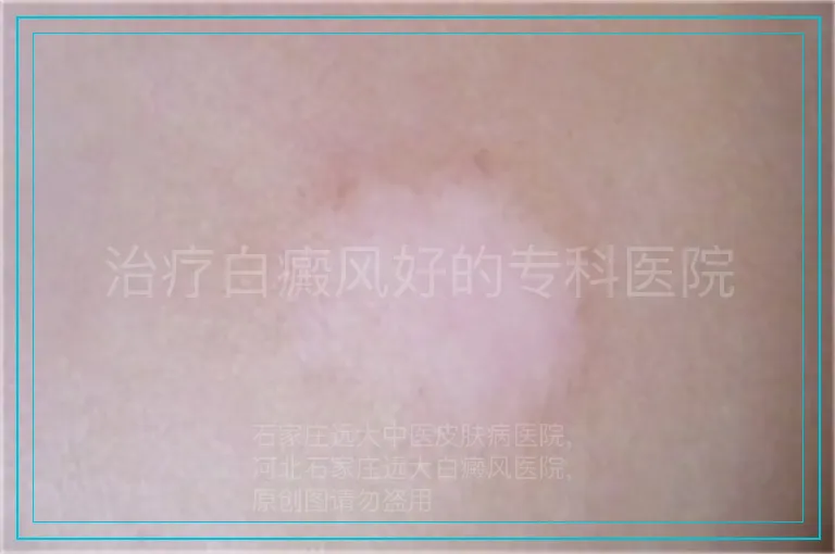 治疗白癜风好的专科医院