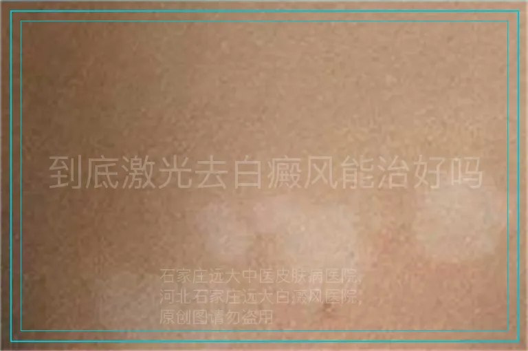 到底激光去白癜风能治好吗