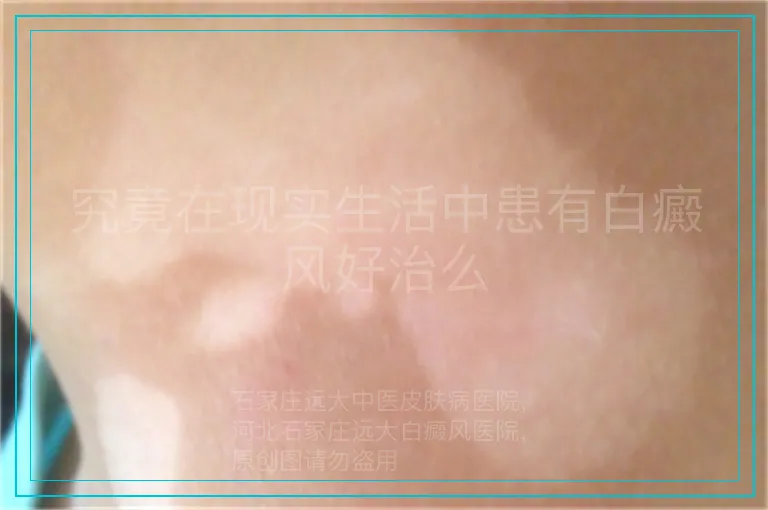 究竟在现实生活中患有白癜风好治么