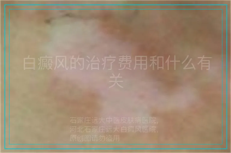 白癜风的治疗费用和什么有关