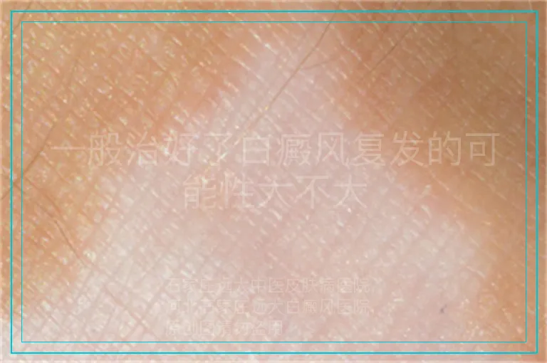 一般治好了白癜风复发的可能性大不大