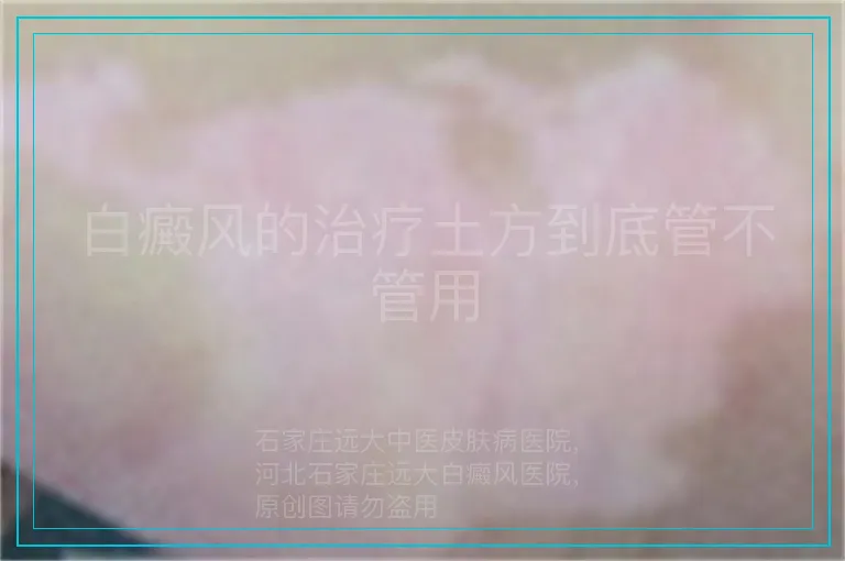 白癜风的治疗土方到底管不管用