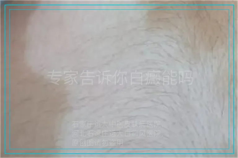 专家告诉你白癜能吗