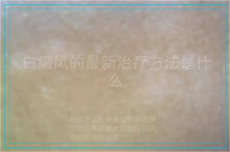 白癜风的最新治疗方法是什么