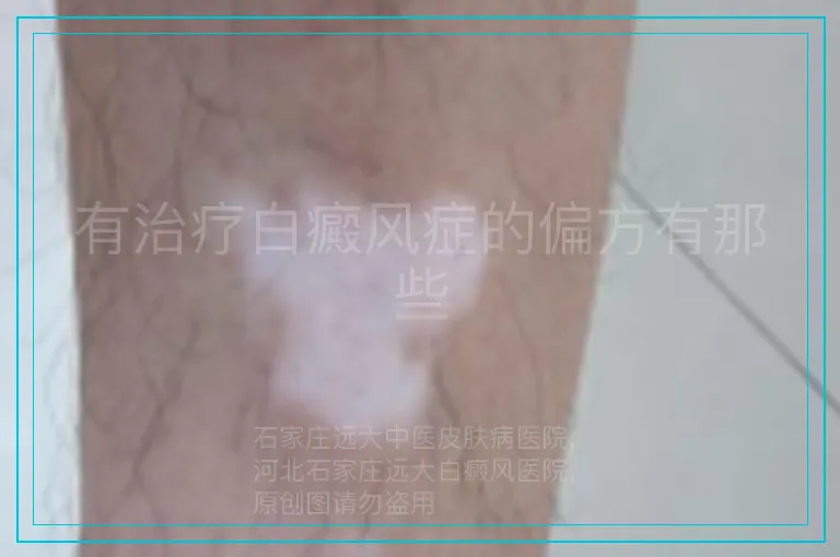 有治疗白癜风症的偏方有那些