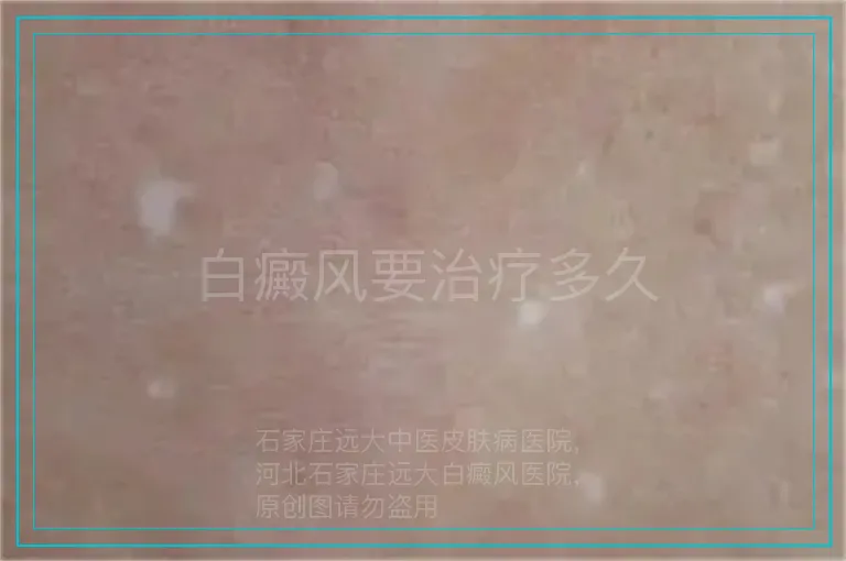 白癜风要治疗多久